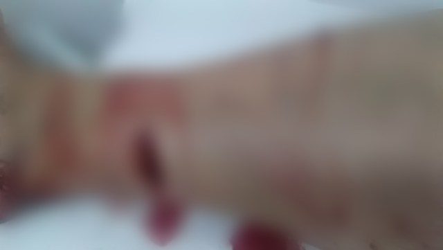 ferimento causado por javali